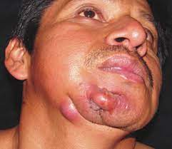 En esta foto se puede observar uno de los síntomas de Actinomicosis.