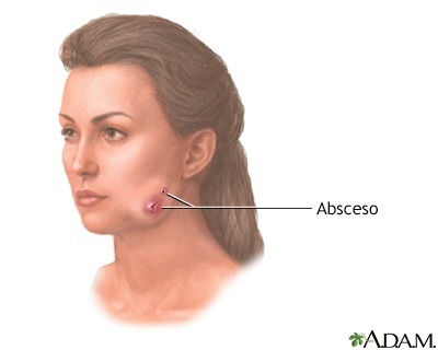 En esta foto se puede observar un dibujo de Actinomicosis.