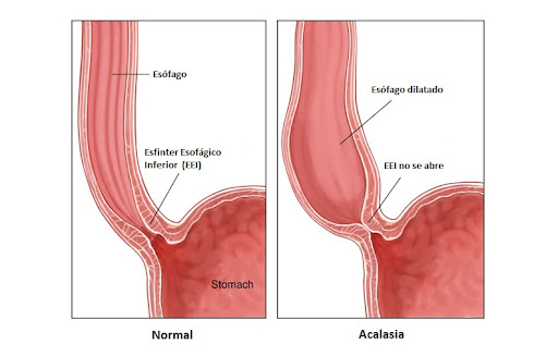 En esta foto se puede observar uno de los síntomas de Acalasia.