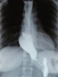 En esta foto se puede observar uno de los síntomas de Acalasia.